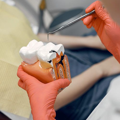 Maqueta de muela con caries